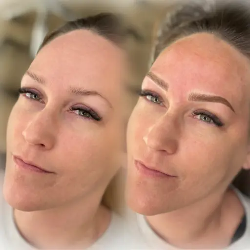 By merging Microblading and Powder Ombre techniques, Combo Brows create hair-like strokes with a soft, shaded effect. This approach combines the precision of Microblading with the depth of Ombre for a natural, balanced result. Customizable to each client's skin type, tone, and aesthetic desires, Combo Brows provide a versatile solution for enhancing brows.