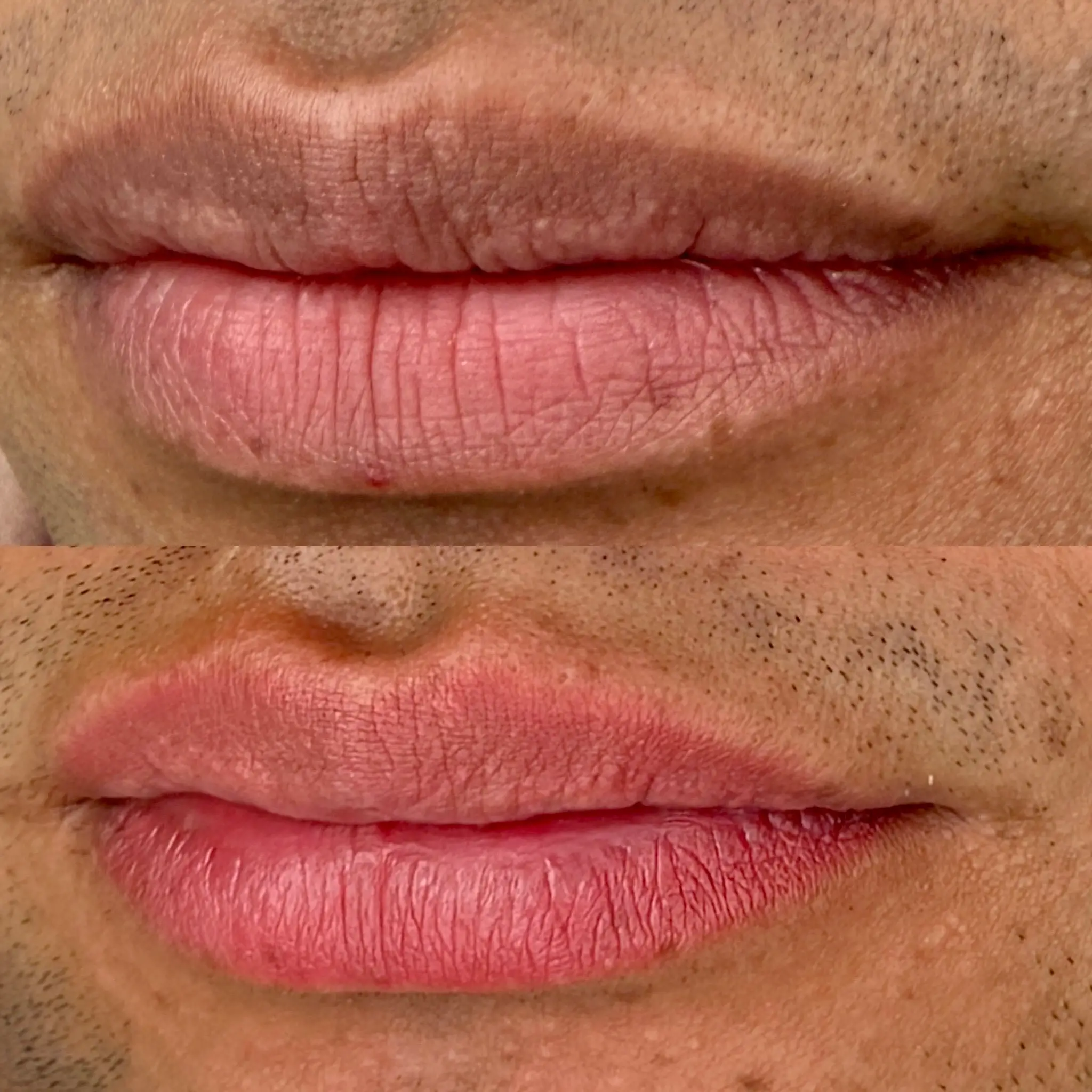 Lip Neutralization